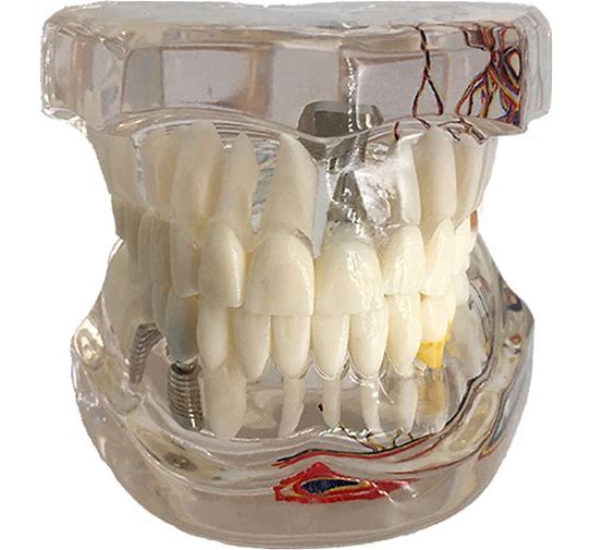 Dental Implant Teeth Model